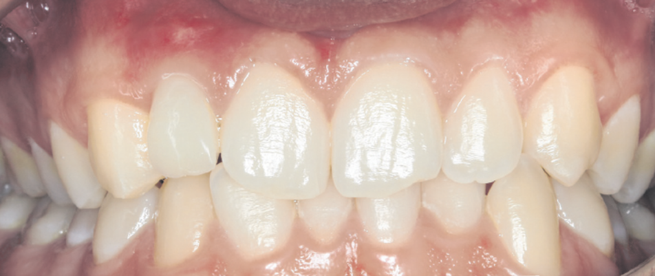 Das Bild zeigt eine Nahaufnahme des Gebisses mit gut gepflegten Zähnen und gesunden, leicht geröteten Zahnfleischrändern.