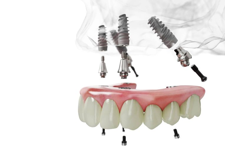 Mehrere Metallimplantate sind in einer zahnfleischähnlichen Basis positioniert und dienen als Halterung für eine herausnehmbare Prothese mit künstlichen Zähnen.
